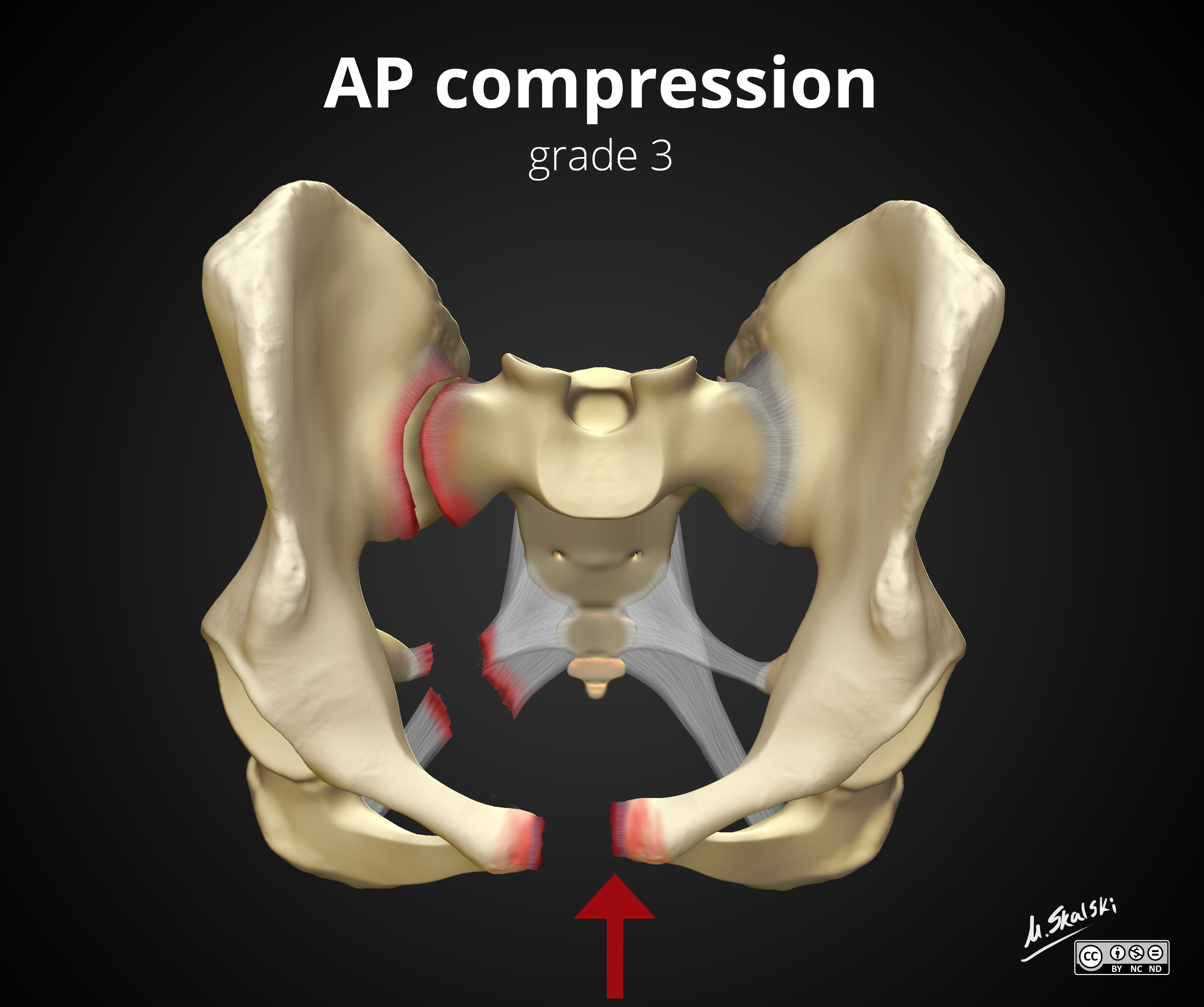 Pelvic fracture diagrams | Image | Radiopaedia.org