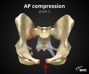 Open book pelvic injury, Radiology Reference Article