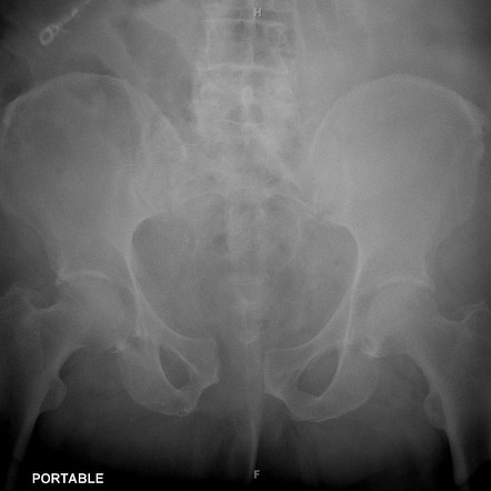 Windswept pelvis | Radiology Reference Article | Radiopaedia.org