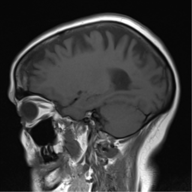 Perivascular space | Image | Radiopaedia.org