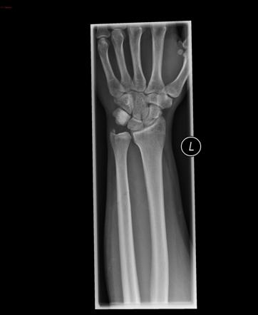 Ulna styloid and shaft fractures | Radiology Case | Radiopaedia.org