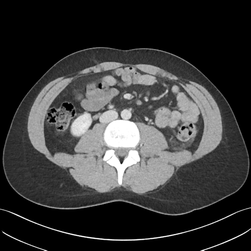 Renal laceration | Image | Radiopaedia.org