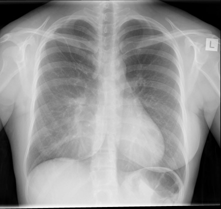 Pectus excavatum | Image | Radiopaedia.org