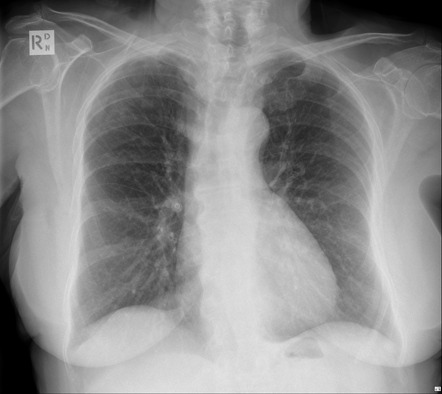 Clothing artifact | Radiology Reference Article | Radiopaedia.org