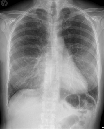 Pectus excavatum with bilateral breast implants | Radiology Case ...