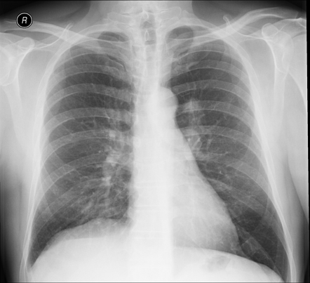 Lung cancer - left upper lobe | Radiology Case | Radiopaedia.org