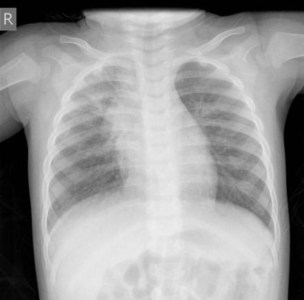 Right upper lobe consolidation: pediatric | Radiology Case ...