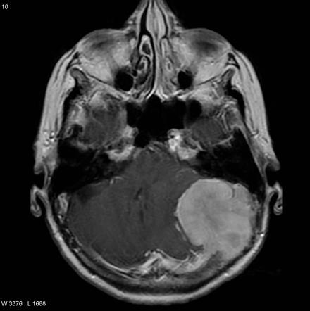 Posterior Fossa Atypical Meningioma Radiology Case Radiopaedia Org