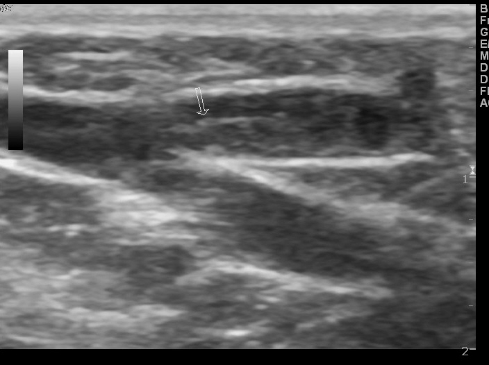 Superficial venous thrombosis | Image | Radiopaedia.org