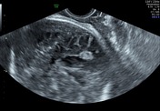 Intraventricular hemorrhage of the newborn | Radiology Reference ...