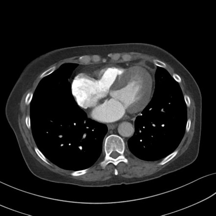 Pericardial fat necrosis | Radiology Case | Radiopaedia.org