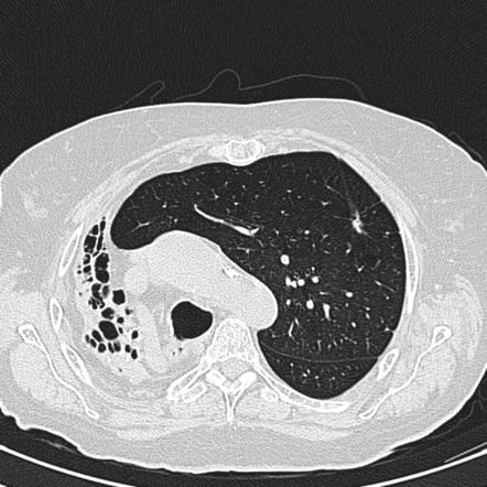 Cystic bronchiectasis | Radiology Case | Radiopaedia.org