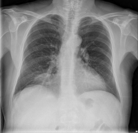 Morgagni hernia | Radiology Case | Radiopaedia.org