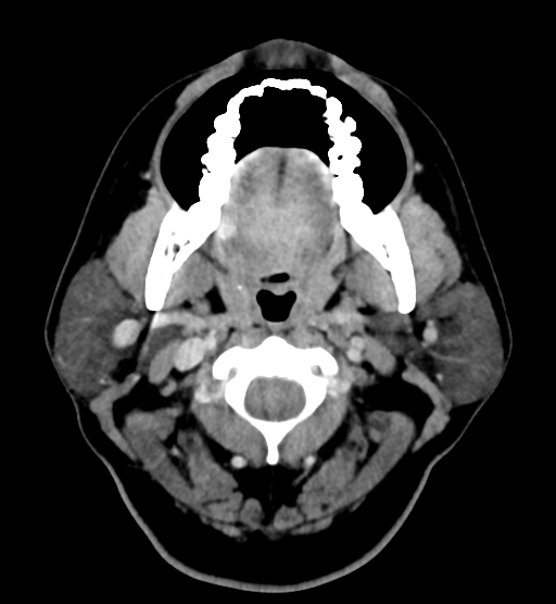 Tongue squamous cell carcinoma | Image | Radiopaedia.org