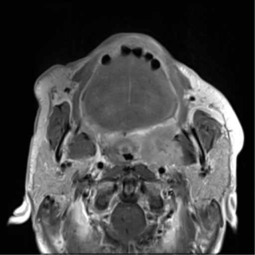 Palatine tonsil squamous cell carcinoma | Image | Radiopaedia.org