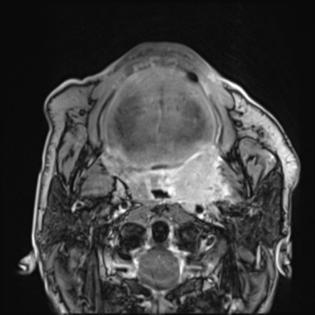 Palatine tonsil squamous cell carcinoma | Image | Radiopaedia.org