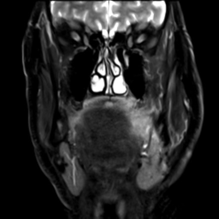 Palatine tonsil squamous cell carcinoma | Image | Radiopaedia.org