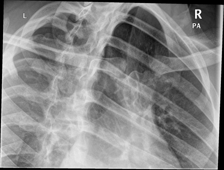 Sternoclavicular joint (anterior oblique views) | Radiology Reference