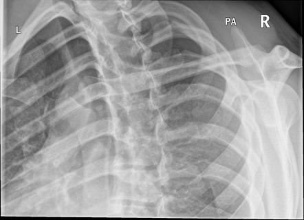 Sternoclavicular Joint Series Radiology Reference Article