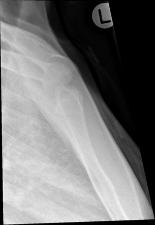 Sternoclavicular joint series | Radiology Reference Article ...