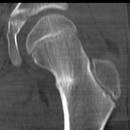 Femoral Neck Stress Fracture Radiology Case Radiopaedia Org