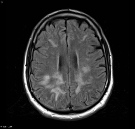 Intravascular lymphoma | Radiology Reference Article | Radiopaedia.org