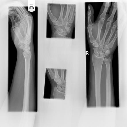 Normal Scaphoid Series 