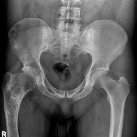 Fibrous dysplasia | Radiology Reference Article | Radiopaedia.org