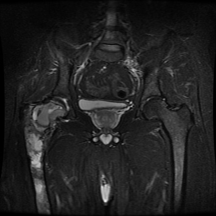 Mazabraud syndrome | Image | Radiopaedia.org