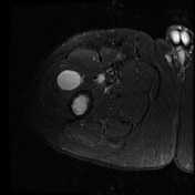 Intramuscular myxoma | Radiology Reference Article | Radiopaedia.org