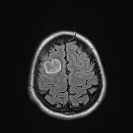 Diffuse astrocytoma NOS | Radiology Case | Radiopaedia.org