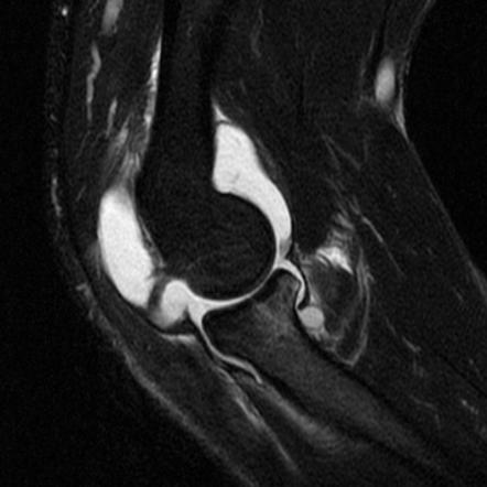 Radial head fracture | Radiology Reference Article | Radiopaedia.org