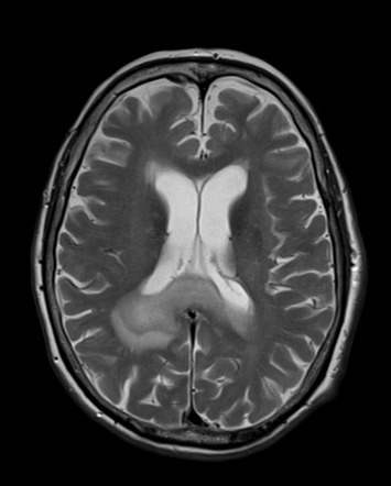 Lymphomas of the central nervous system | Radiology Reference Article ...