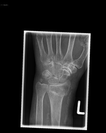 Colles Fracture Radiology Reference Article Radiopaedia Org