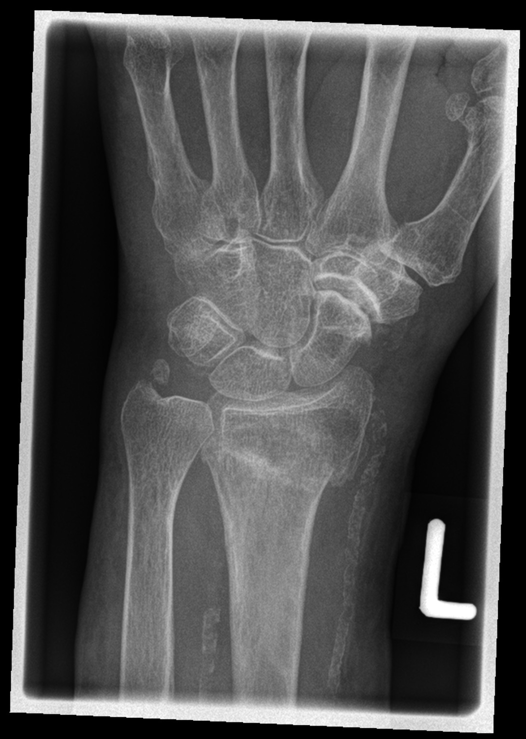 Distal radial fracture - Colles fracture | Image | Radiopaedia.org