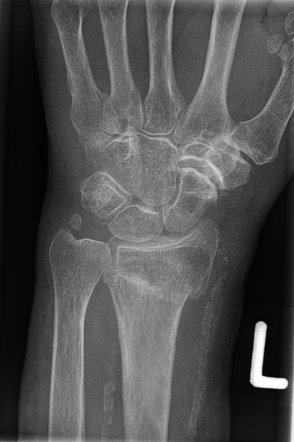 Distal Radial Fracture - Colles Fracture 