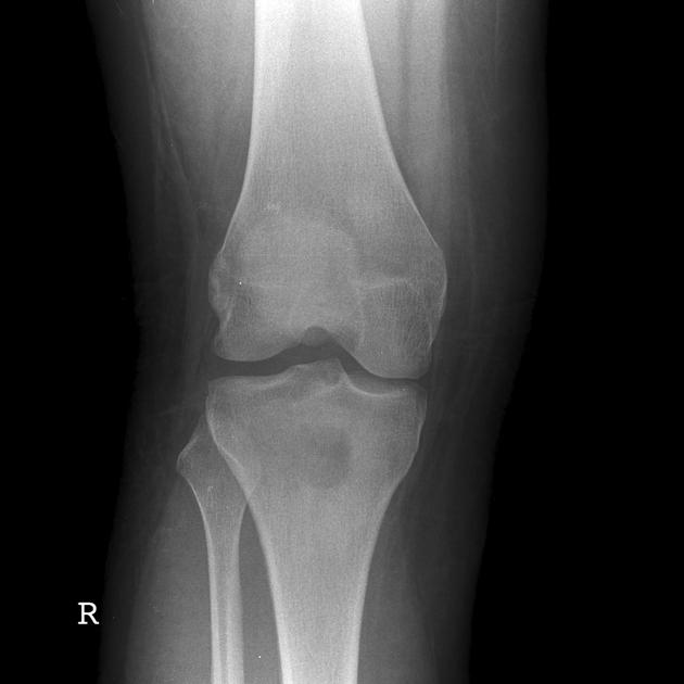 Osteoid osteoma | Radiology Reference Article | Radiopaedia.org