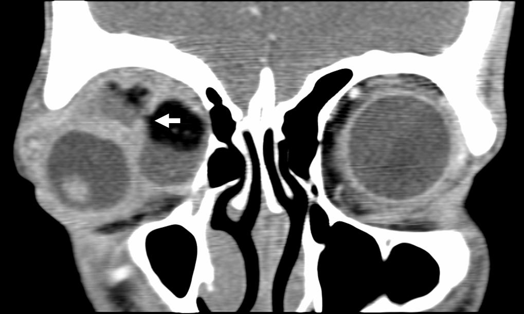 Ruptured Orbital Dermoid Cyst Image