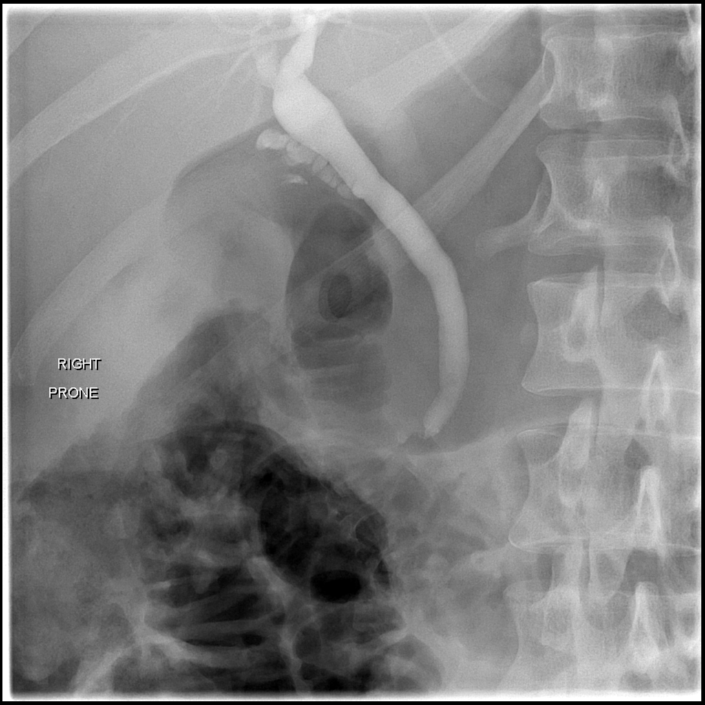 Cholelithiasis and choledocholithiasis | Image | Radiopaedia.org