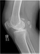 Primary synovial chondromatosis | Radiology Reference Article ...