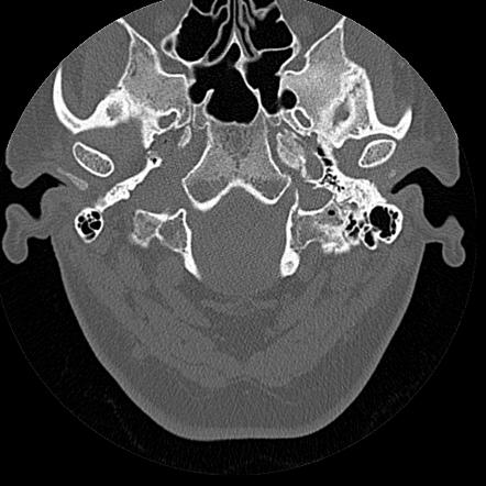 Bilateral ossifications of the external auditory canal | Image