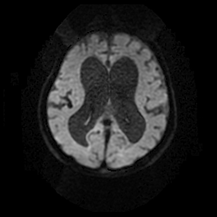 Mucopolysaccharoidosis: neuroimaging and skeletal survey | Image ...