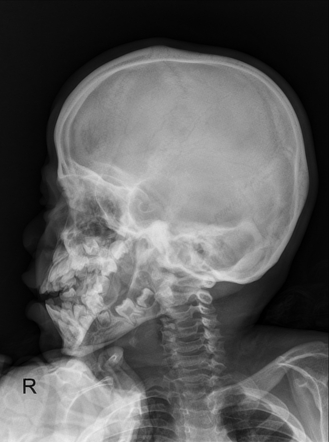 Mucopolysaccharoidosis: neuroimaging and skeletal survey | Image ...