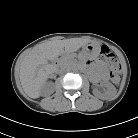 Liver Ct Scan