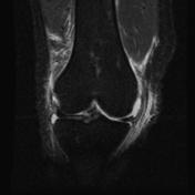 O'Donoghue unhappy triad | Radiology Reference Article | Radiopaedia.org