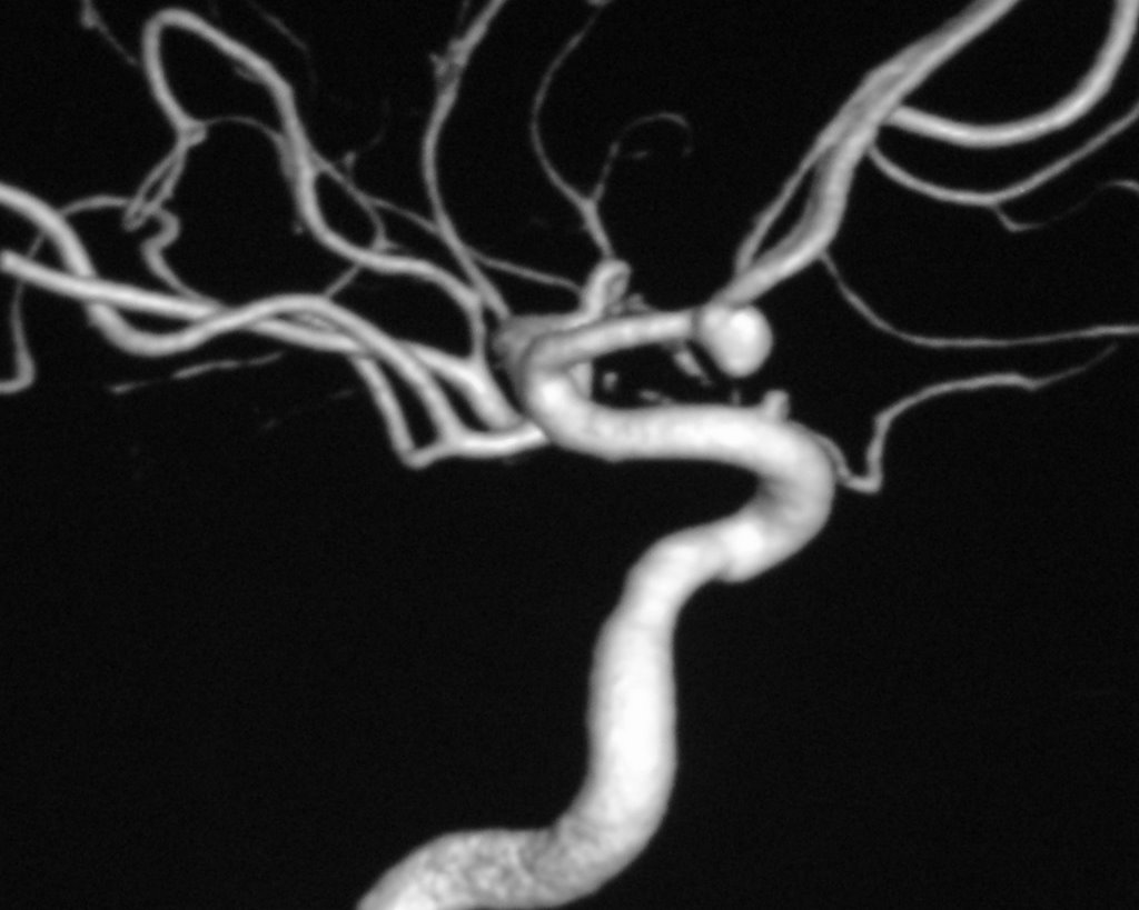 Аневризма сосудов мозга. СКТ-ангиография сосудов головного. Кт ангиография аневризма. Кт ангиография аневризма головного мозга. Ангиография сосудов головного мозга аневризма.