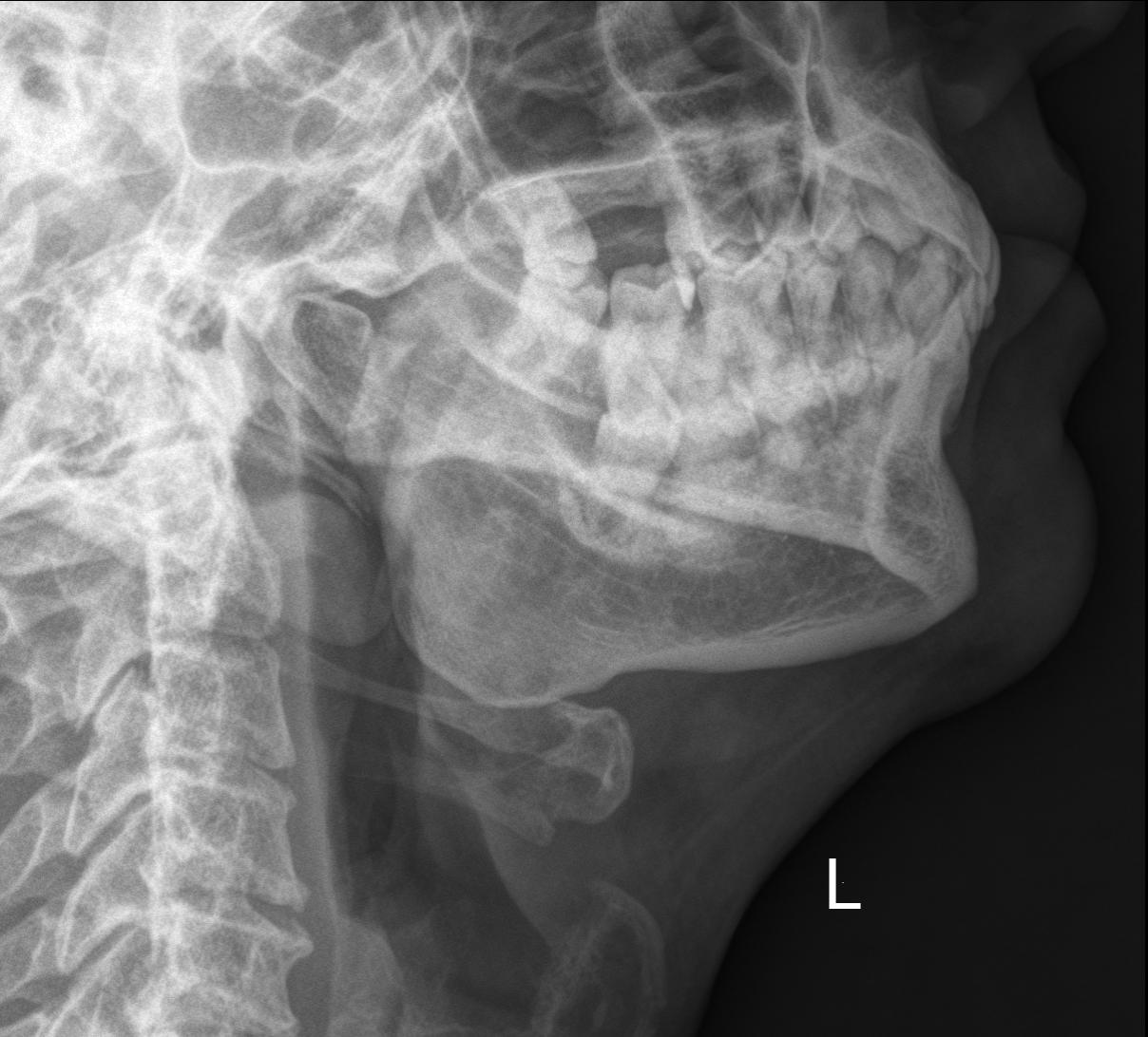 Normal x-ray: submandibular region (extra-oral radiography) | Image