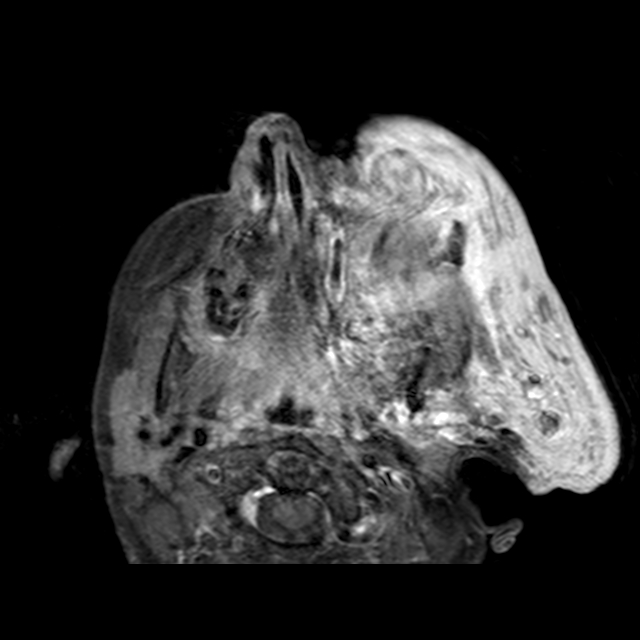 Plexiform Neurofibroma Nf1 Image 8610