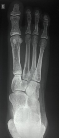 Postaxial longitudinal defect | Radiology Case | Radiopaedia.org