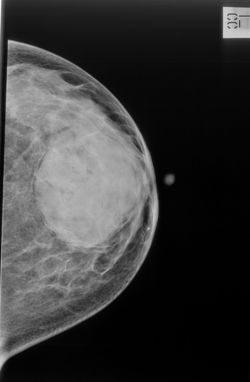 Giant Fibroadenoma Image